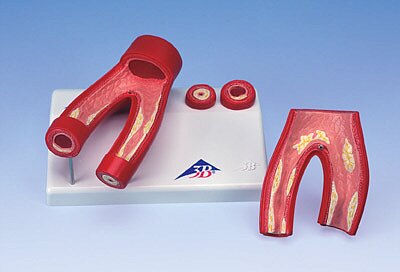 Modelo de arteriosclerosis con sección transversal de la arteria, de 2 piezas G40